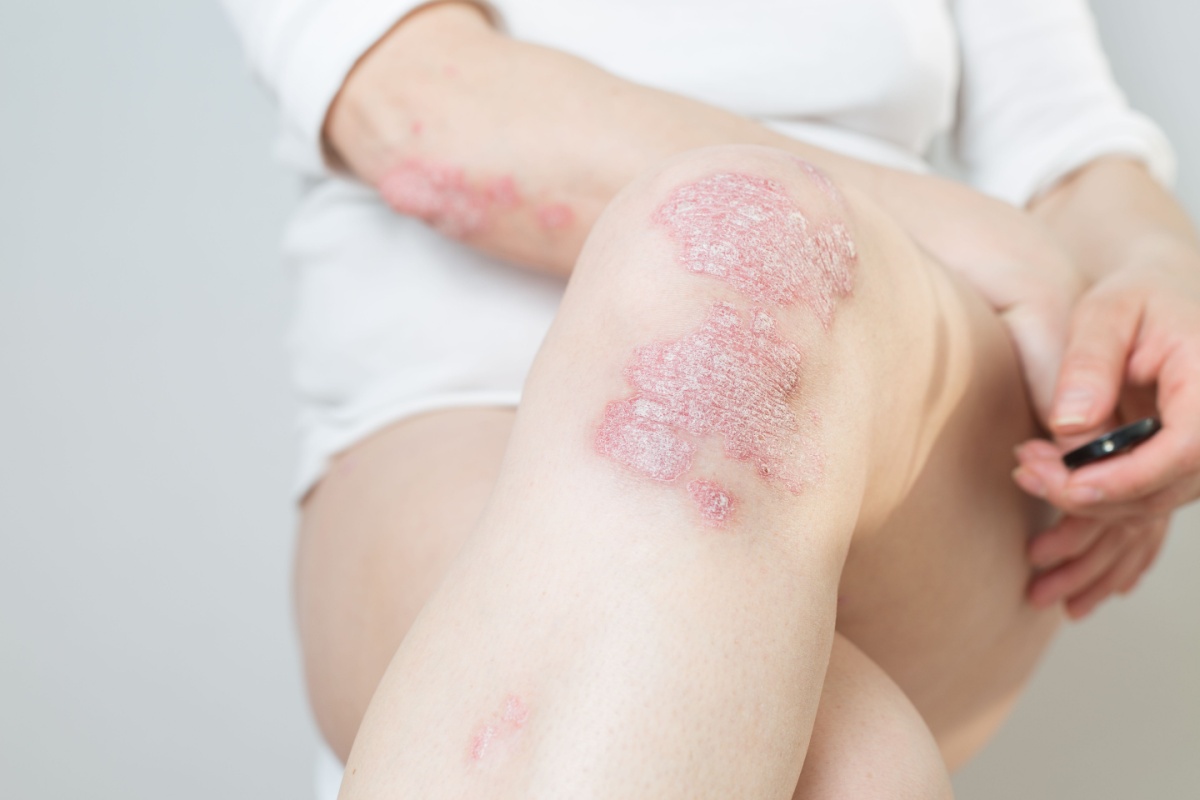 pacienta cu psoriazis semne specifice bolii in zona genunchiului