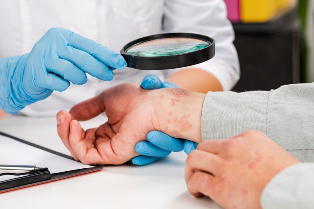dermatolog examinand cu lupa mana unui pacient cu psoriazis